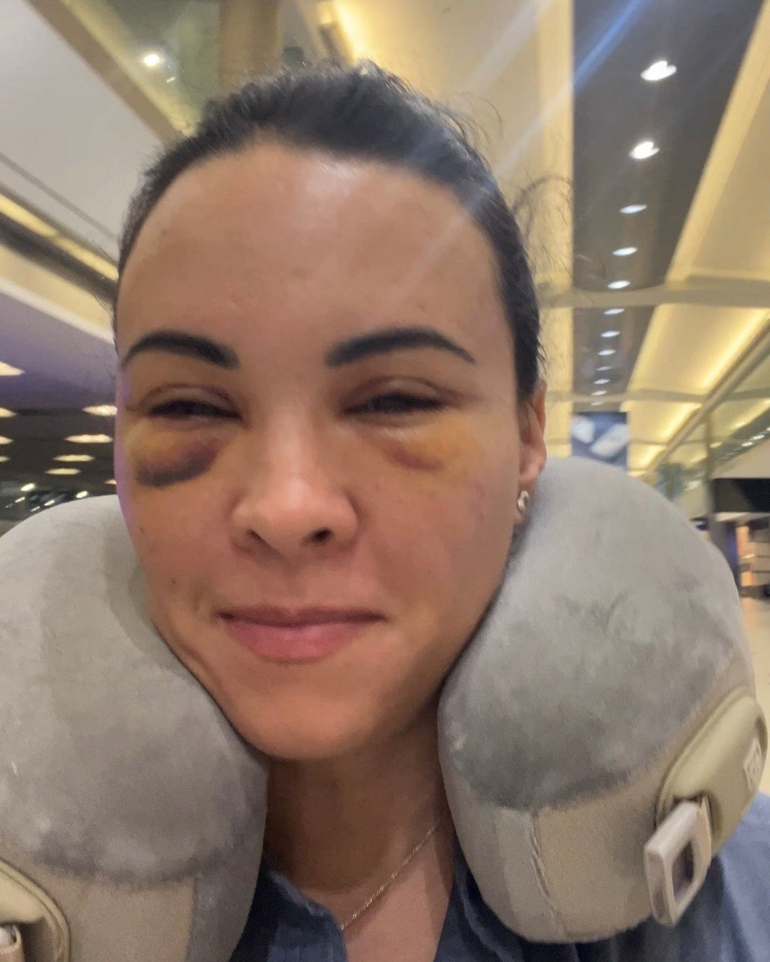 THE DAYS AFTER: My Blepharoplasty Recovery Story